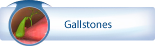 Gallstones