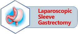 Laparoscopic Sleeve Gastrectomy