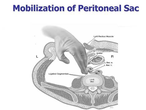 Abdominal sac (peritoneal sac)